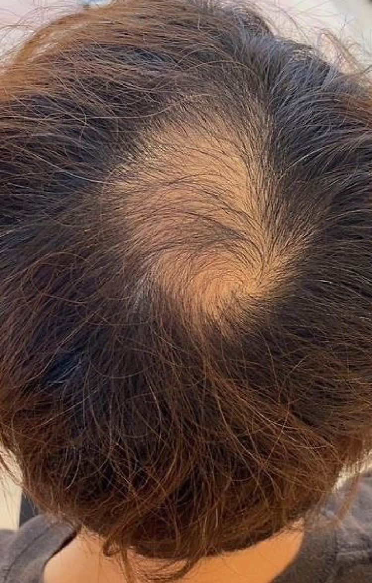 50代男性 M字の薄毛 Before