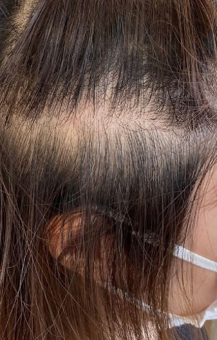 40代女性 分け目の薄毛 Before
